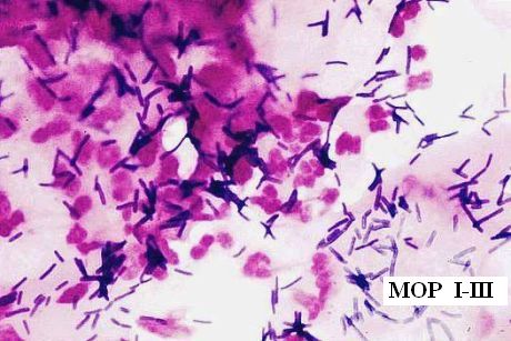 Obr.3: Přechodný MOP I - III, převaha leukocytů, laktobacily a ojediněle grampozitivní koky, kultivačně S.agalactiae (GBS), zvětšeno 1500x