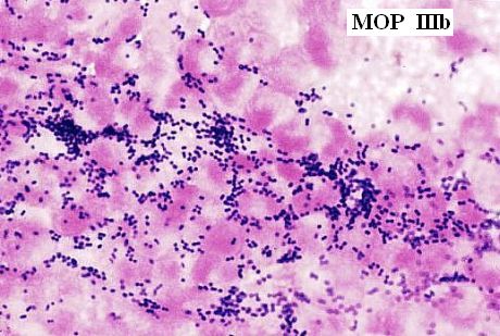 Obr.4: MOP IIIb, masivně leukocyty a grampozitivní koky bez laktobacilů, kultivačně S.agalactiae (GBS), zvětšeno 1500x